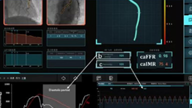 冠狀動脈血流儲備分?jǐn)?shù)測量系統(tǒng)（蘇州潤邁德）